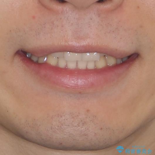 気になる八重歯を抜歯矯正で改善　補助装置を用いたインビザライン矯正の治療前（顔貌）