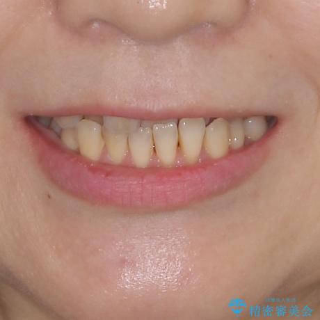 前歯のクロスバイトを治したい　インビザラインによる矯正治療の治療前（顔貌）