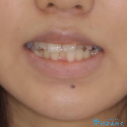 急速拡大装置で狭い歯列を骨格ごと改善　ワイヤー装置による矯正治療の治療前（顔貌）