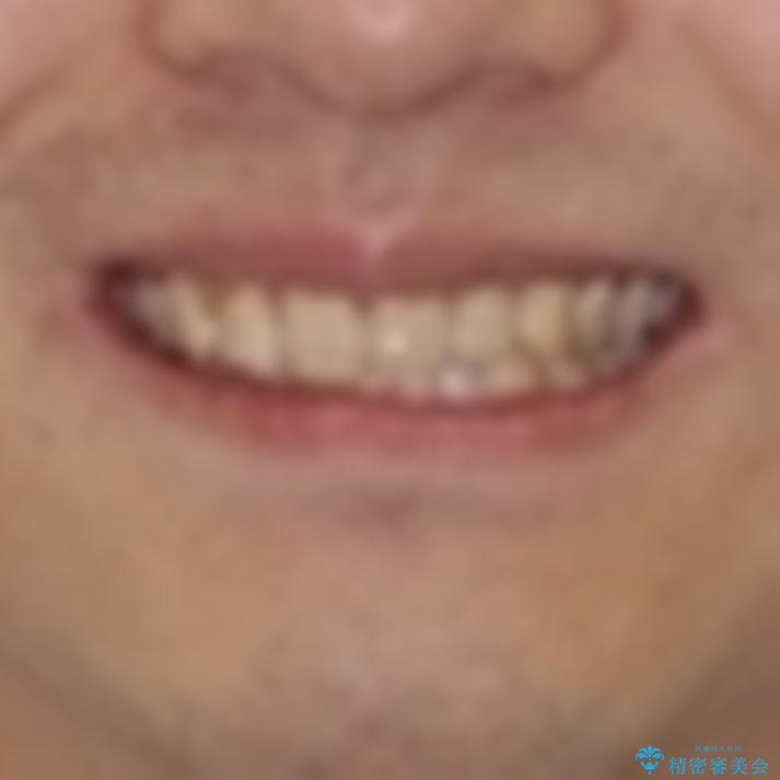 気になる前歯を治したい 短期間でのインビザライン矯正の治療前(顔貌)