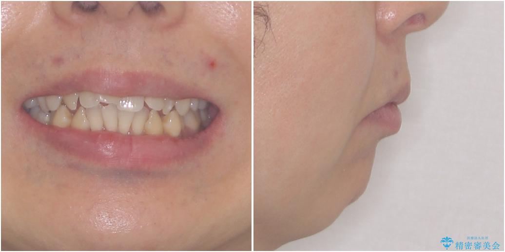 掃除しにくい前歯と閉じにくい口元　目立たないワイヤー装置での抜歯矯正の治療前（顔貌）