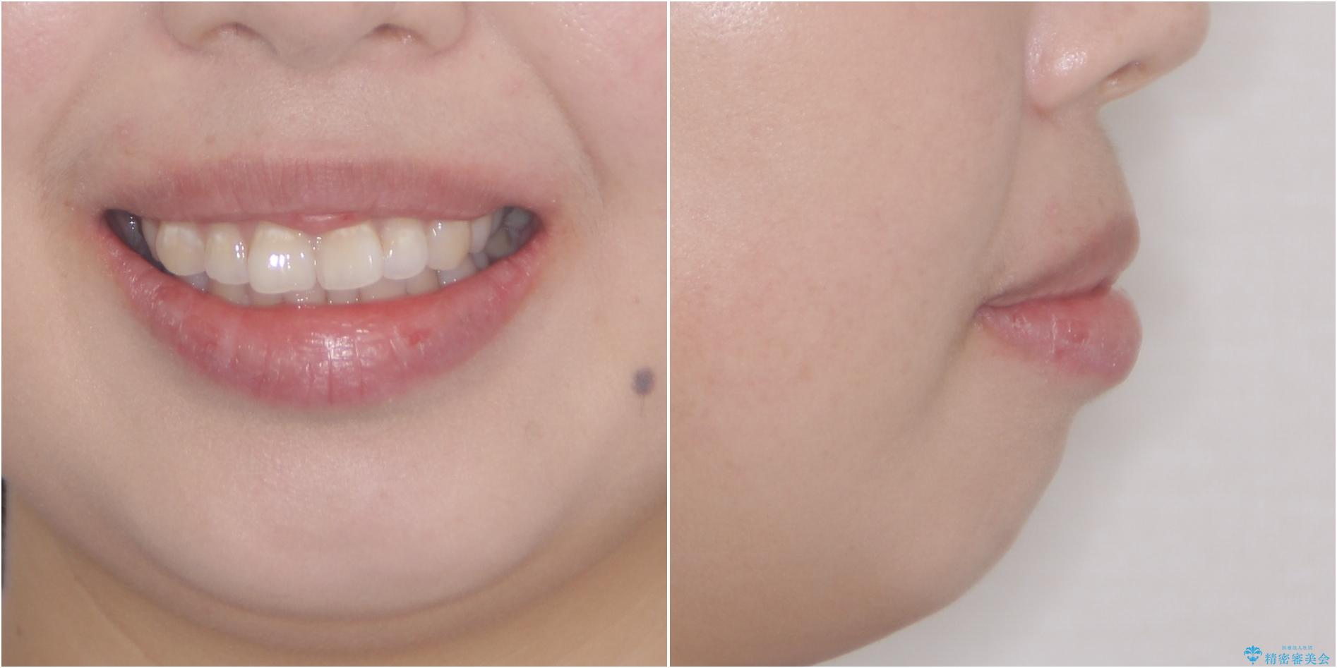 ふっくらとした口元を改善したい　目立たないワイヤー装置による抜歯矯正の治療前（顔貌）