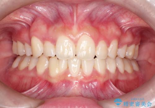 【インビザライン】抜歯矯正の症例 治療後