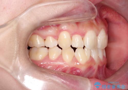 【インビザライン】抜歯矯正の治療後