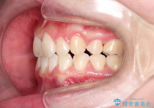 【インビザライン】抜歯矯正の治療後
