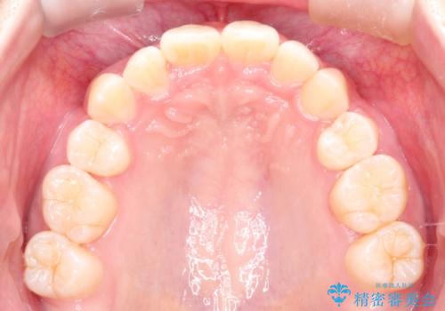 【インビザライン】抜歯矯正の治療後