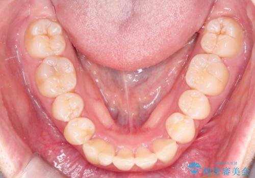 【インビザライン】抜歯矯正の治療後
