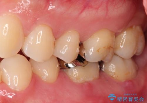 根管治療から被せ物の治療の治療前