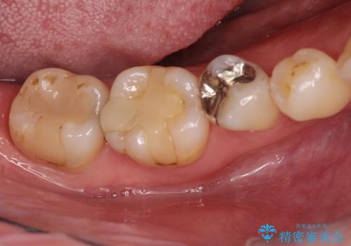 保険診療のCRインレーをセラミックインレーでやり直しの治療前