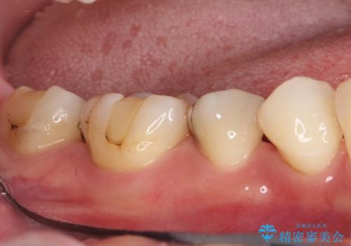 保険診療のCRインレーをセラミックインレーでやり直しの治療前