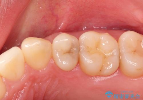 適合の良いセラミックインレー の治療前