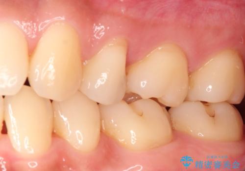 適合の良いセラミックインレー の治療前