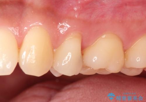 適合の良いセラミックインレー の治療前