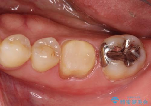 根管治療から被せ物の治療の治療中