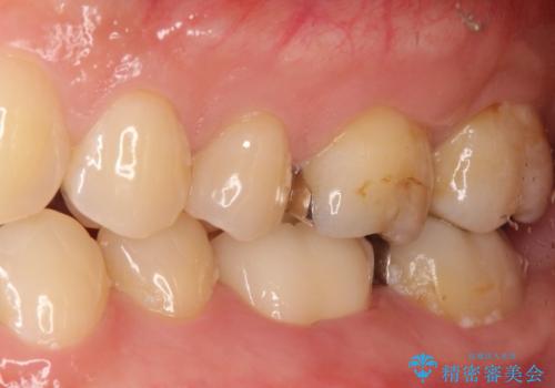 根管治療から被せ物の治療の治療後