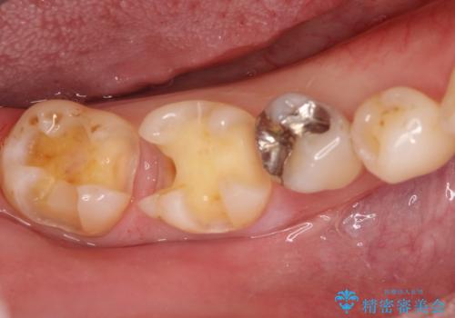 保険診療のCRインレーをセラミックインレーでやり直しの治療中