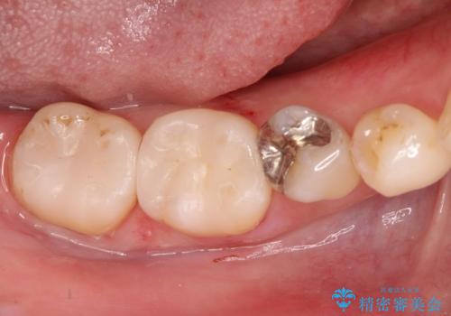保険診療のCRインレーをセラミックインレーでやり直しの治療後