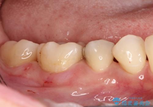 保険診療のCRインレーをセラミックインレーでやり直しの治療後