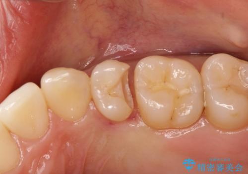 適合の良いセラミックインレー の治療中