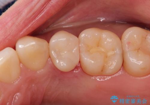 適合の良いセラミックインレー