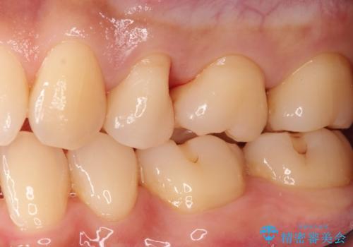 適合の良いセラミックインレー の治療後