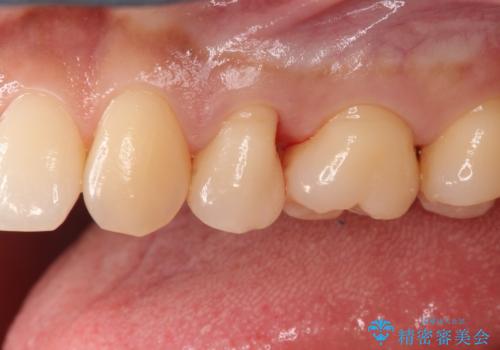 適合の良いセラミックインレー の治療後