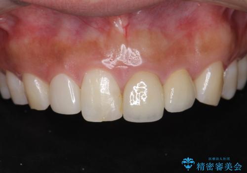 [ 歯が小さい ] 根管治療を伴う矮小歯治療の治療後