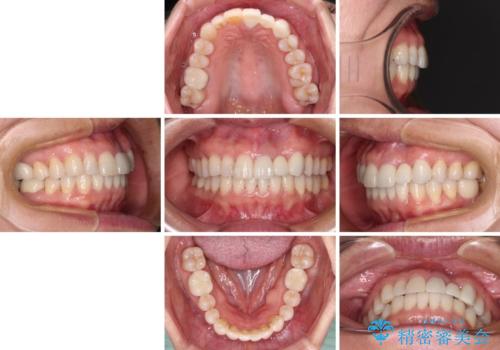 口元の突出感を治したい　治療中の歯も治したいの治療後