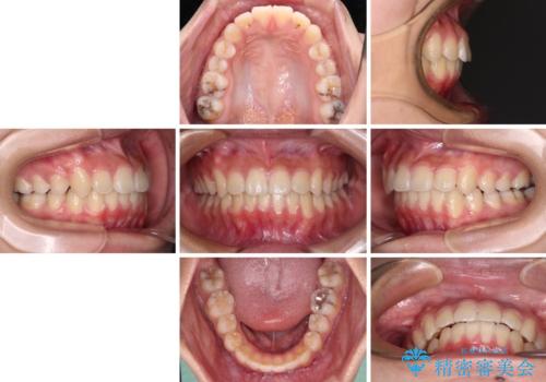 急速拡大装置で狭い歯列を骨格ごと改善 ワイヤー装置による矯正治療の治療後