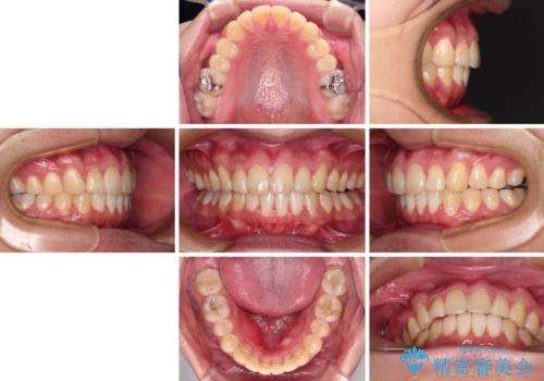 気になる前歯を治したい 短期間でのインビザライン矯正の治療後