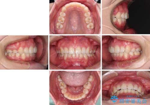 ふっくらとした口元を改善したい　目立たないワイヤー装置による抜歯矯正の治療後
