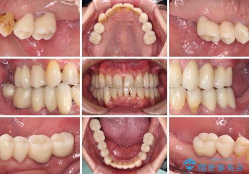 歯並びや奥歯の痛み 色々と治したい 総合歯科診療の治療後