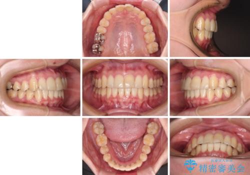 上下前歯のデコボコをきれいに インビザラインによる矯正治療の治療後