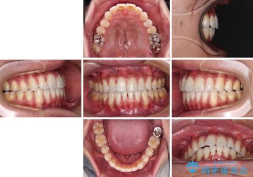 上顎の狭い歯列をインビザラインで拡大の治療後