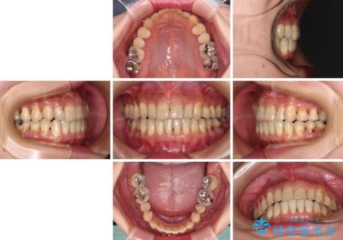 どこで咬んで良いのか分からない インビザラインでの咬み合わせの改善の治療後