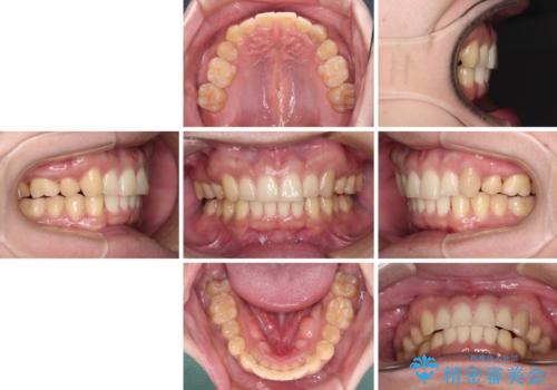 気になる八重歯を抜歯矯正で改善 補助装置を用いたインビザライン矯正の治療後