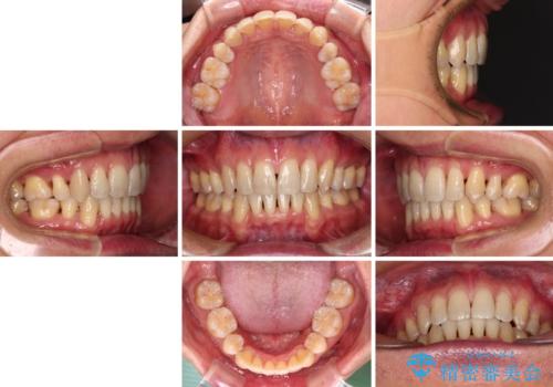 掃除しにくい前歯と閉じにくい口元 目立たないワイヤー装置での抜歯矯正の治療後