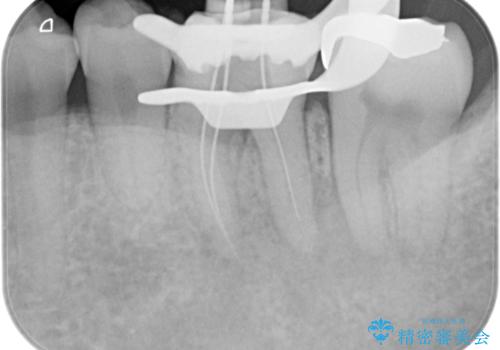 根管治療から被せ物の治療の治療中
