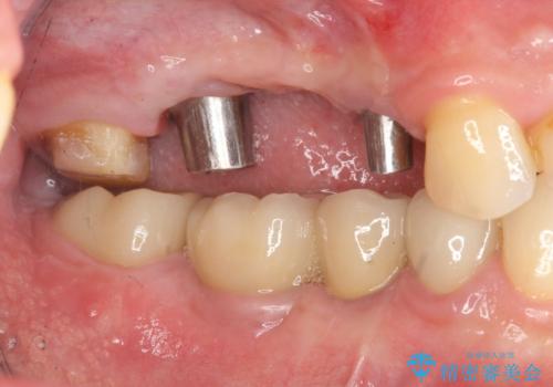 インプラント治療・セラミック治療を含む  全顎的虫歯治療の治療中