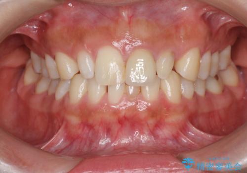 [ 歯が小さい ] 根管治療を伴う矮小歯治療の治療前