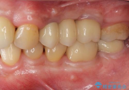 インプラント治療・セラミック治療を含む  全顎的虫歯治療の治療後