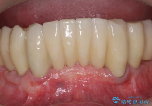 「 歯周病 再生治療 」再生治療で歯を残すの症例 治療後