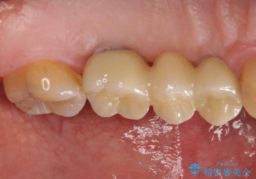 インプラント治療・セラミック治療を含む  全顎的虫歯治療の治療後