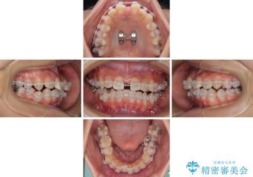 急速拡大装置で狭い歯列を骨格ごと改善 ワイヤー装置による矯正治療の治療中