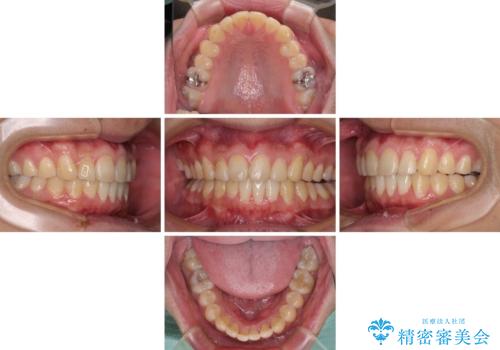 気になる前歯を治したい 短期間でのインビザライン矯正の治療中