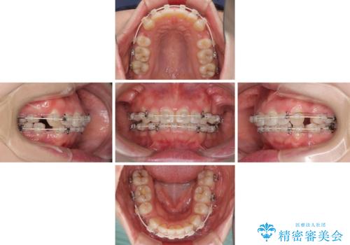 ふっくらとした口元を改善したい 目立たないワイヤー装置による抜歯矯正の治療中