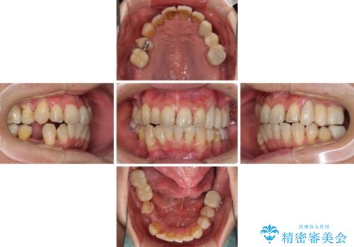 歯並びや奥歯の痛み 色々と治したい 総合歯科診療の治療中