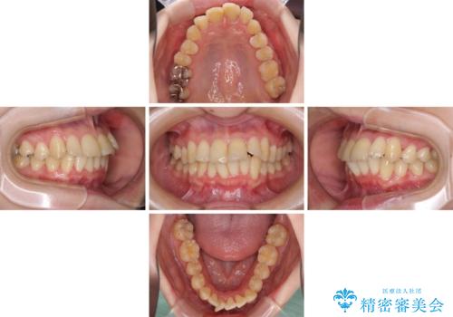 上下前歯のデコボコをきれいに インビザラインによる矯正治療の治療中