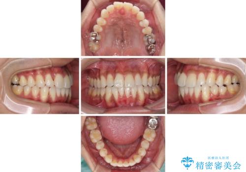 上顎の狭い歯列をインビザラインで拡大の治療中