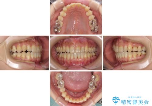 どこで咬んで良いのか分からない インビザラインでの咬み合わせの改善の治療中